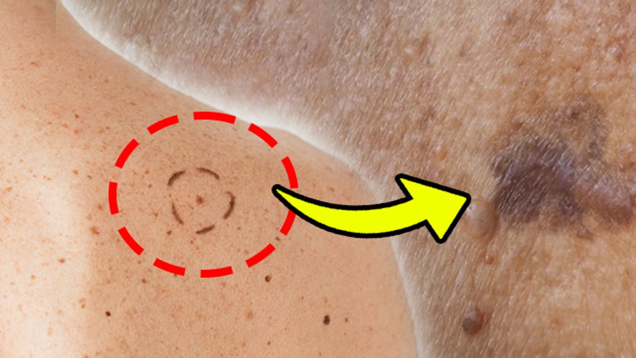 Skin Cancer Causes: Skin Cancer Kyu Aur Kaise Hota Hai, Symptoms In Hind| Boldsky