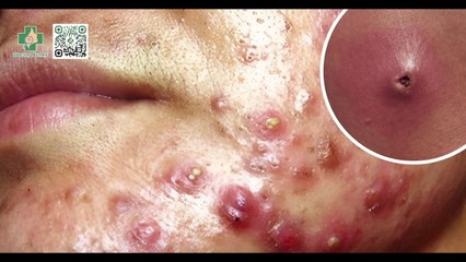 Mụn bọc bao lâu thì chín? Có nên trị mụn bọc tại nhà?