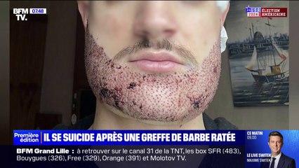 "Il souffrait, il avait mal, il ne dormait plus": Mathieu, 24 ans, s'est suicidé après une greffe de barbe ratée en Turquie
