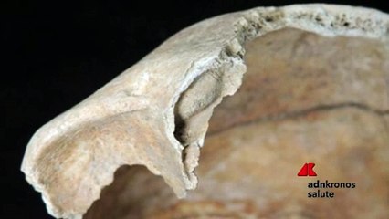 In uno scheletro di mille anni fa il più antico cancro alle ossa