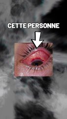 Il se retrouve avec des asticots .. Dans les yeux !