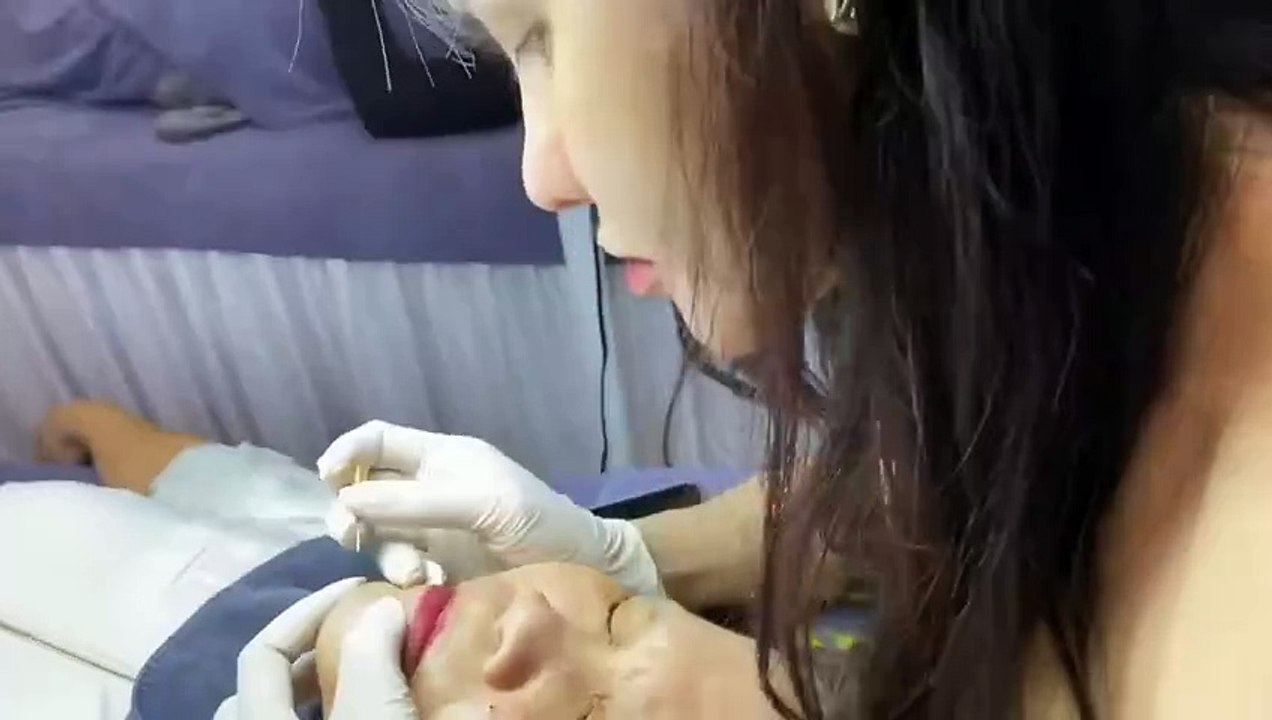 Big Cystic Acne Blackheads Extraction Blackheads & Milia, Whiteheads Removal Pimple Popping # 1355