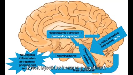 "new research on migraine raise the prospects of better therapies"