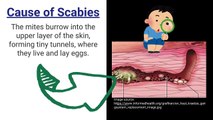 Scabies_ Signs, Symptoms, Causes, Prevention and Treatment_ Novice Medic