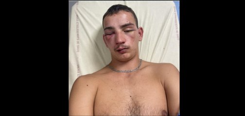 Le témoignage de Mathéo, 19 ans, frappé à coups de pieds dans la tête à la sortie d'une boîte à Dijon pour lui voler son portable  : "J'ai perdu connaissance. Heureusement, le cerveau n'a pas été touché"