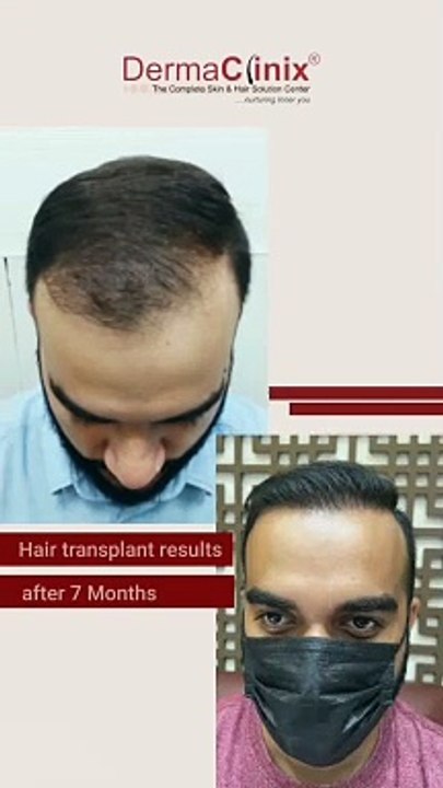 Remarkable Transformation with B.E.S.T. FUE by Dr. Amrendra Kumar at DermaClinix