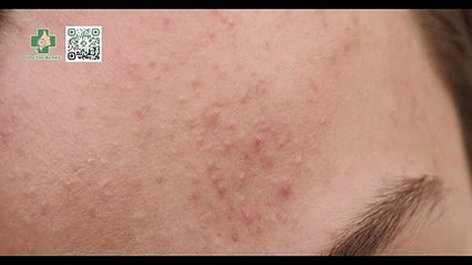 Đẩy mụn là gì? Quá trình đẩy mụn kéo dài bao lâu?