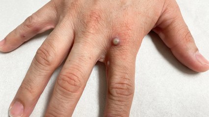 Mpox: What is it? What are the symptoms? How is it spread?