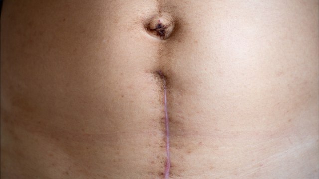 Fast gestorben nach der Geburt: Mutter überlebt „fleischfressende Bakterien“