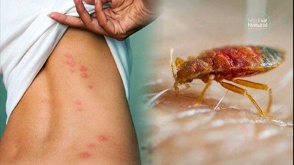 Tratamiento Casero para Picaduras de Chinches 🐛🏠