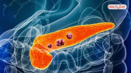 ప్యాంక్రియాటిక్ క్యాన్సర్ కు సంబంధించిన ప్రారంభ సంకేతాలు | Early Signs of Pancreatic Cancer | Telugu