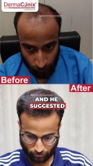 What Harshit Said About DermaClinix: Amazing Results with Dr. Kavish Chouhan