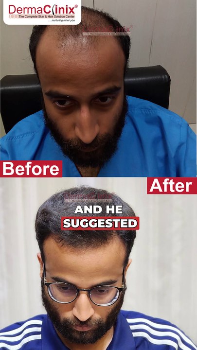 What Harshit Said About DermaClinix: Amazing Results with Dr. Kavish Chouhan