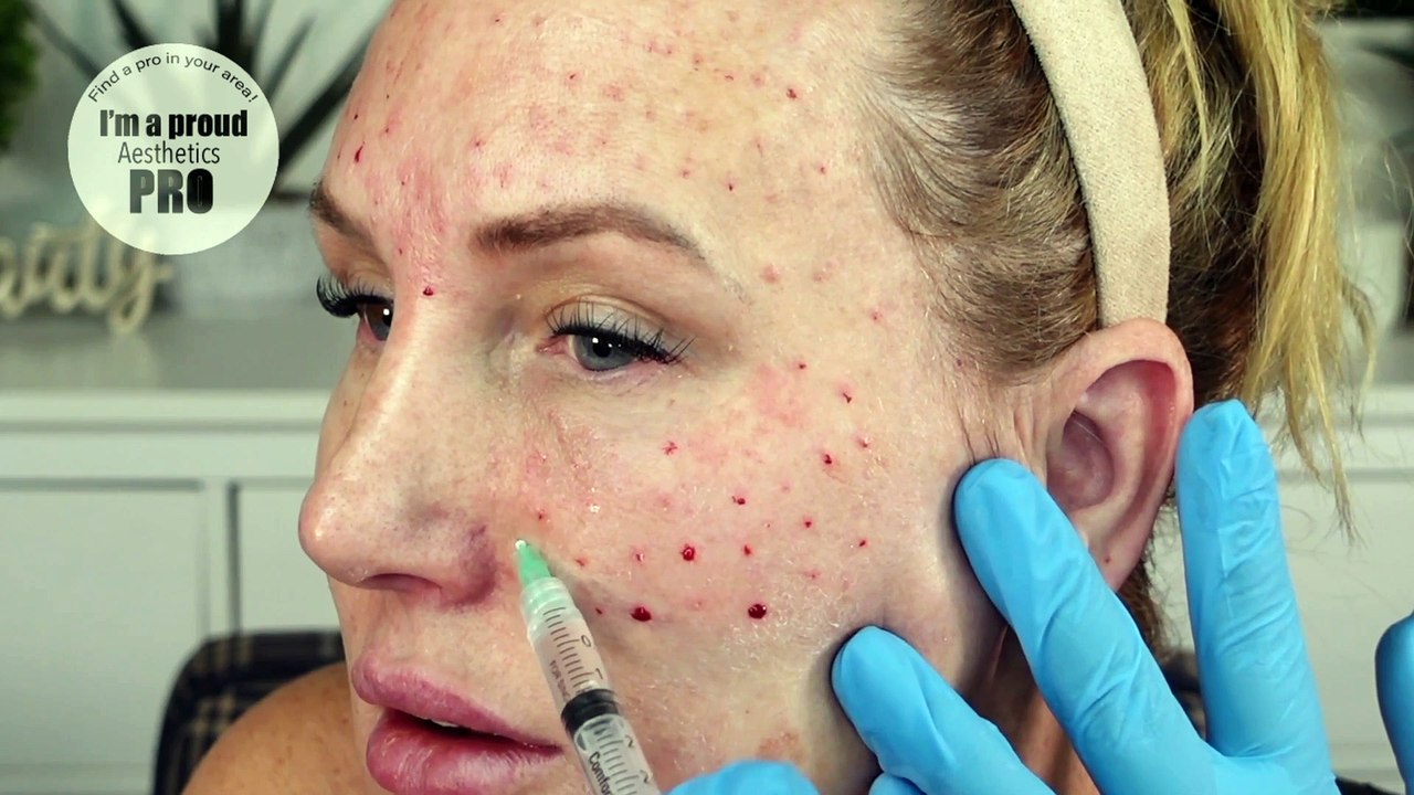 Mesotherapy Tutorial Using LemonBottle Skin Booster