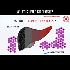 What is liver cirrhosis?