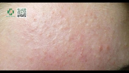 Có nên nặn mụn ẩn không? Khi nào nên nặn mụn ẩn?