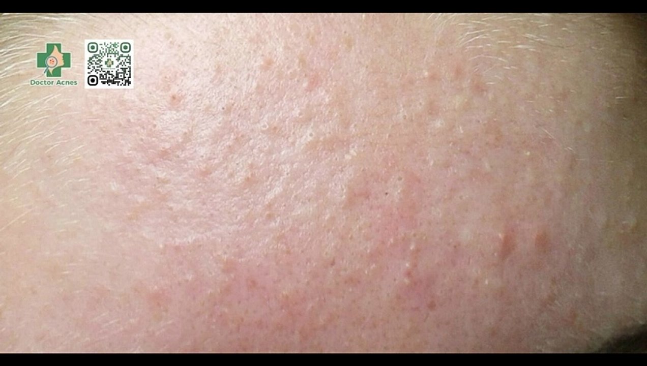 Có nên nặn mụn ẩn không? Khi nào nên nặn mụn ẩn?