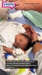 Si kecil lena dibuai mimpi sambil kaki disimen demi merawat masalah kaki bengkoknya