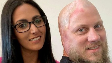 "I had 5% chance of survival after my head was electrocuted by 4,160 volts"