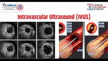 clot in transit #pocus #cardiology #emergencymedicine|Clot in Transit: Diagnosing and Treating a Silent Threat"