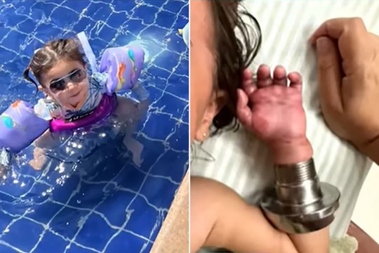 A toddler's arm got stuck in a swimming pool filter