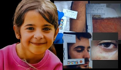 Narin Güran cinayeti soruşturmasında Enes Güran'ın kolundaki izlerin görüntüleri ortaya çıktı