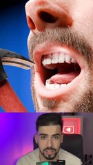 Si tu casses ta dent