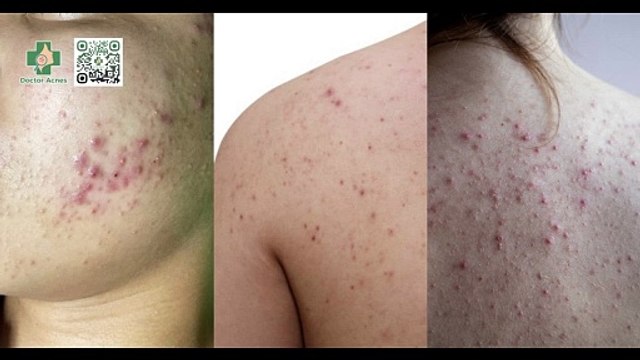 Mụn trứng cá: nguyên nhân, cách điều trị và phòng ngừa mụn