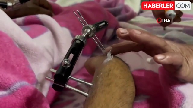 Düğününe bir hafta kala kaza geçiren damadın hayalleri suya düştü