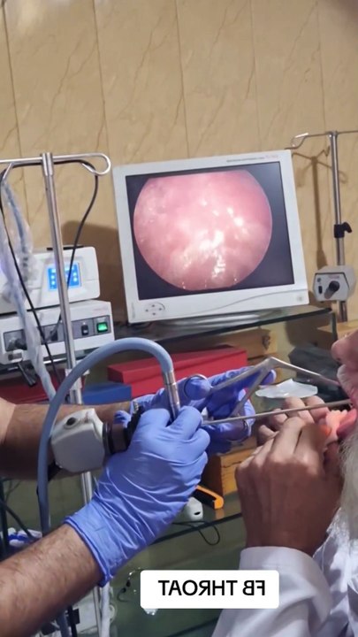 BIGGEST EARWAX REMOVAL | Huge Ear Wax Finally Removed