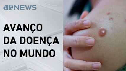 EUA confirma primeiro caso de nova variante da Mpox