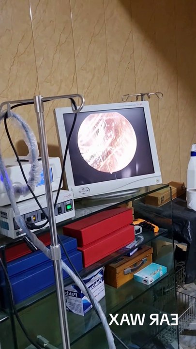 Biggest Ear Wax Removal