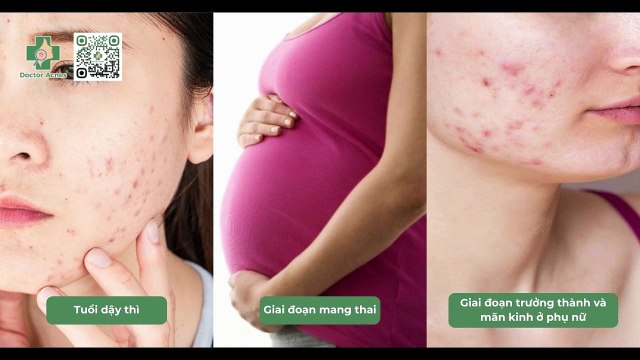 Cách trị mụn nội tiết sau sinh hiệu quả, an toàn