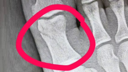 Man shares short but not-so-sweet story of how he cracked his toe while practicing a handstand