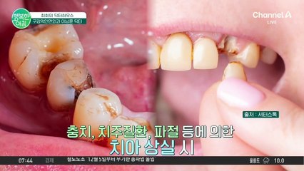 [닥터하우스] 치아가 빠지면 생기는 실♨ 오래 건강한 치아 관리하는 법! #치아상실