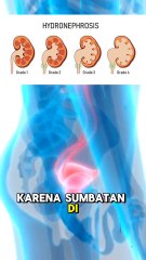 Apakah kamu tahu Hidronefrosis itu apa? Silakan simak penjelasannya di SIni