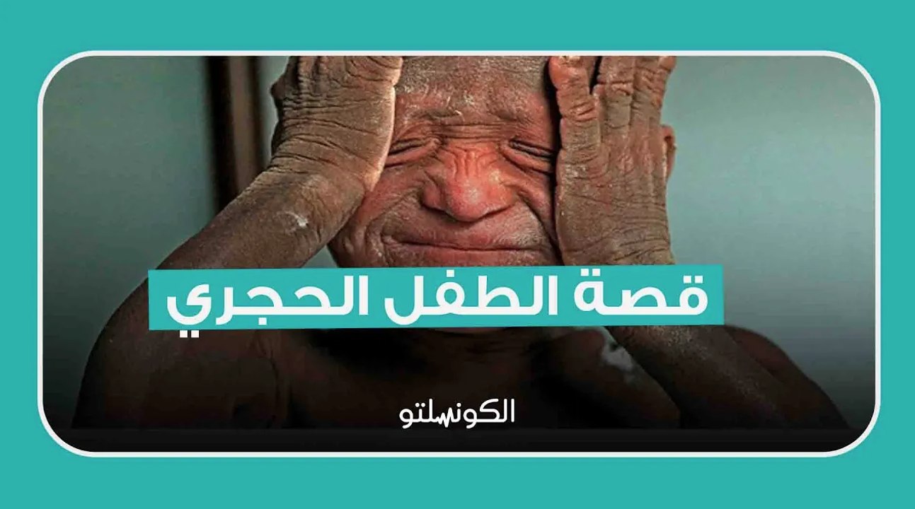 مرض يُحول طفل لتمثال حي- ماذا حدث؟