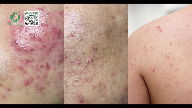 Bí quyết điều trị mụn trứng cá tận gốc hiệu quả và an toàn