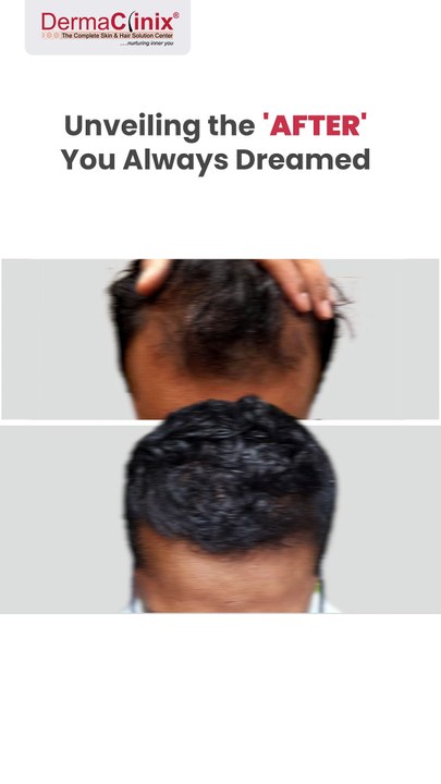 3 Months Hair Transplantation Results India | Dr Amrendra Kumar | DermaClinix