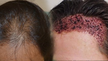 Hair Transplant Side Effect: Itching,Swelling To Infection, Hair Transplant Side Effects On Scalp..