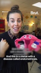 Living with endometriosis