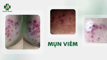 Mụn viêm ở má: nguyên nhân và cách điều trị
