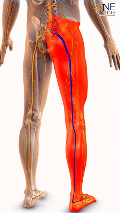 Life-Changing Spine Surgery मरीज़ ने बताई अपनी रिकवरी की कहानी One Spine Clinic (1)