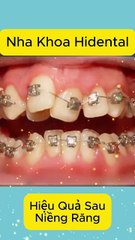 Hiệu Quả Sau Khi Niềng Răng