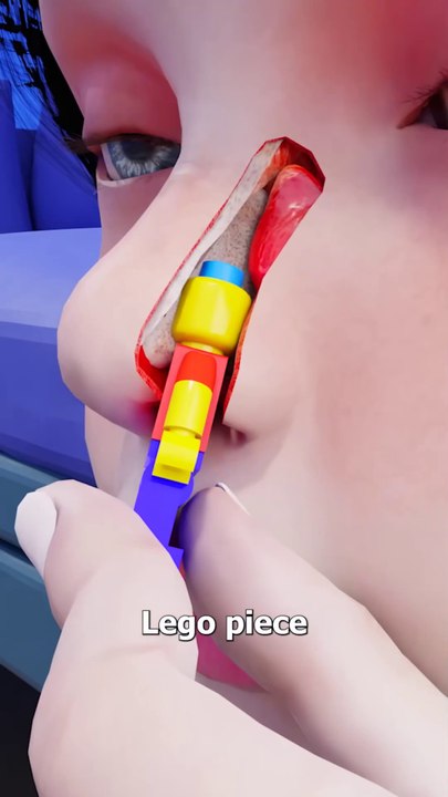 Lego Stuck In Nose For 26 Years 😨