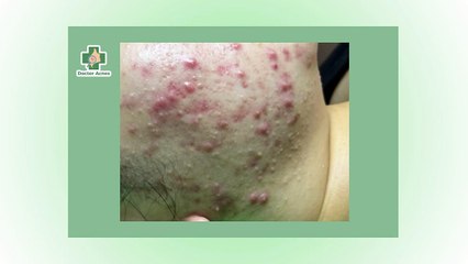 Mụn viêm là gì? Cách điều trị và phòng ngừa hiệu quả