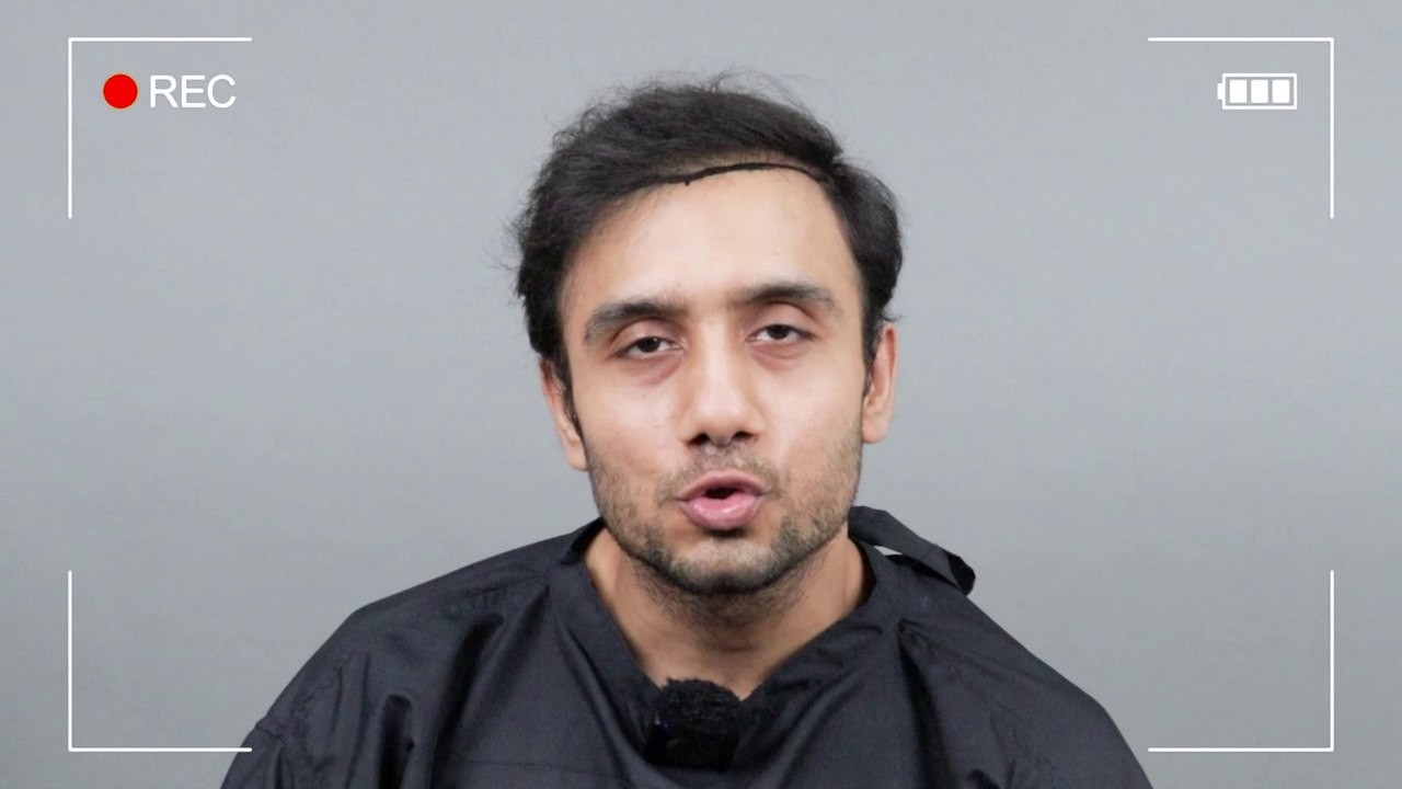 Hair Transplant Clinic for Failed Hair Transplant Repair in India | Best Corrective Hair Transplant