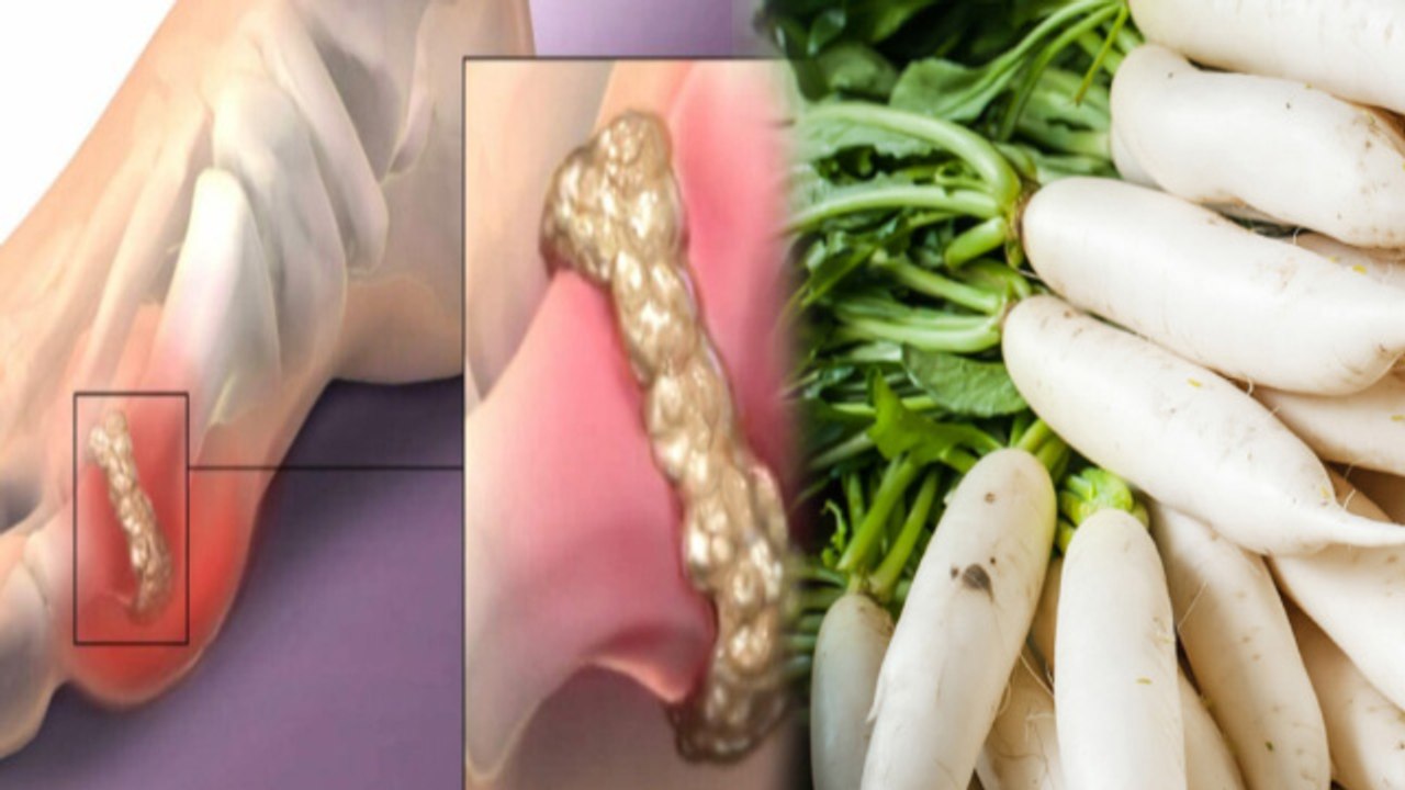 Uric Acid Me Muli Khana Chahiye Ya Nahi | Is Raddish Good For High Uric Acid