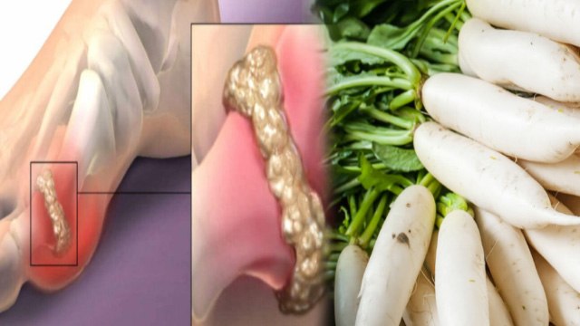 Uric Acid Me Muli Khana Chahiye Ya Nahi | Is Raddish Good For High Uric Acid