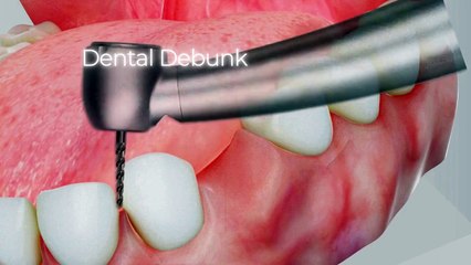 Crown placement on tooth #DentalDebunk